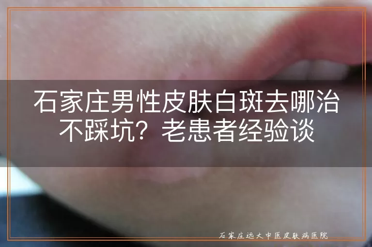 石家庄男性皮肤白斑去哪治不踩坑？老患者经验谈