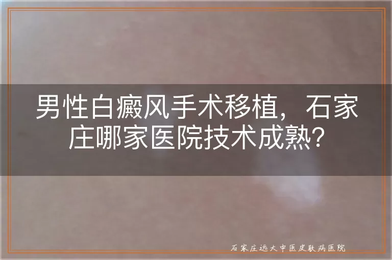 男性白癜风手术移植，石家庄哪家医院技术成熟？