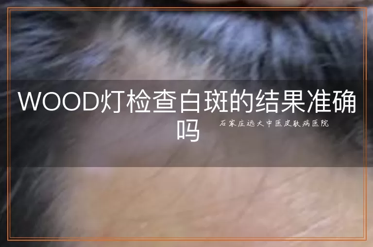 WOOD灯检查白斑的结果准确吗