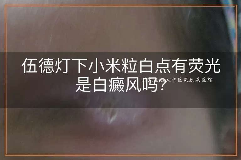 伍德灯下小米粒白点有荧光是白癜风吗？