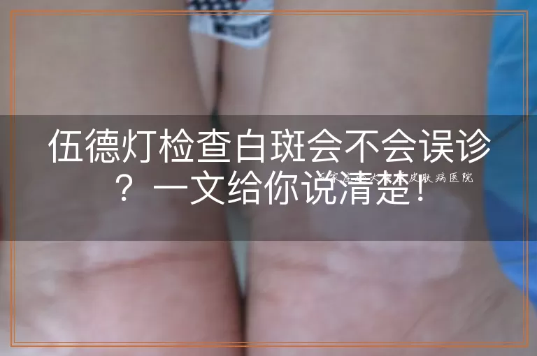 伍德灯检查白斑会不会误诊？一文给你说清楚！