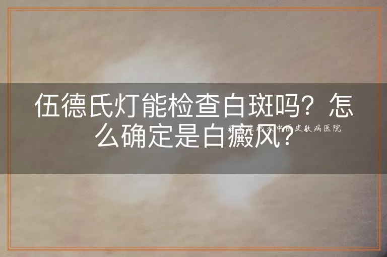 伍德氏灯能检查白斑吗？怎么确定是白癜风？