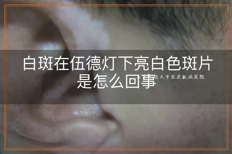 白斑在伍德灯下亮白色斑片是怎么回事