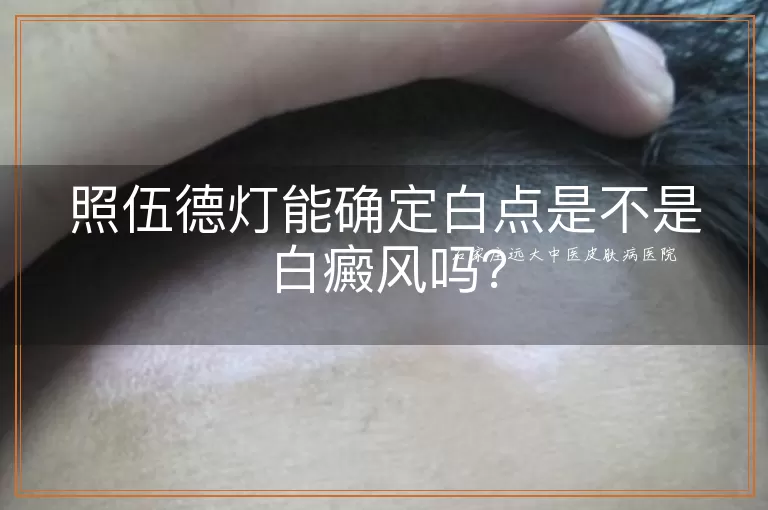 照伍德灯能确定白点是不是白癜风吗？
