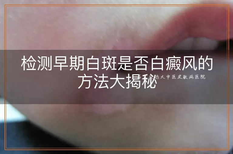 检测早期白斑是否白癜风的方法大揭秘
