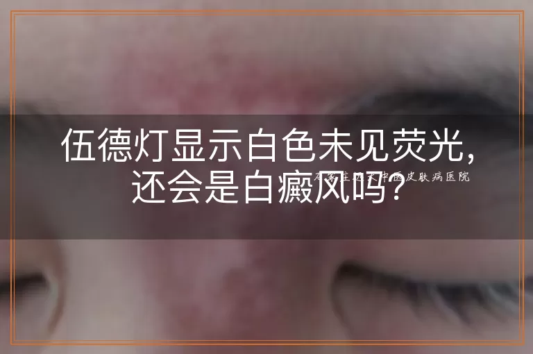 伍德灯显示白色未见荧光，还会是白癜风吗？