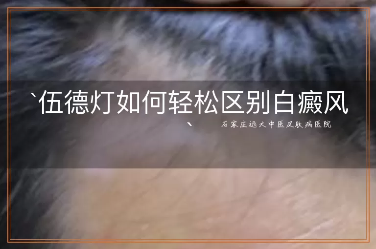 伍德灯如何轻松区别白癜风
