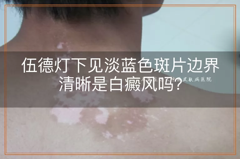 伍德灯下见淡蓝色斑片边界清晰是白癜风吗？