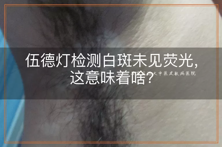 伍德灯检测白斑未见荧光，这意味着啥？