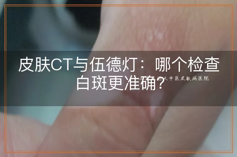 皮肤CT与伍德灯：哪个检查白斑更准确？