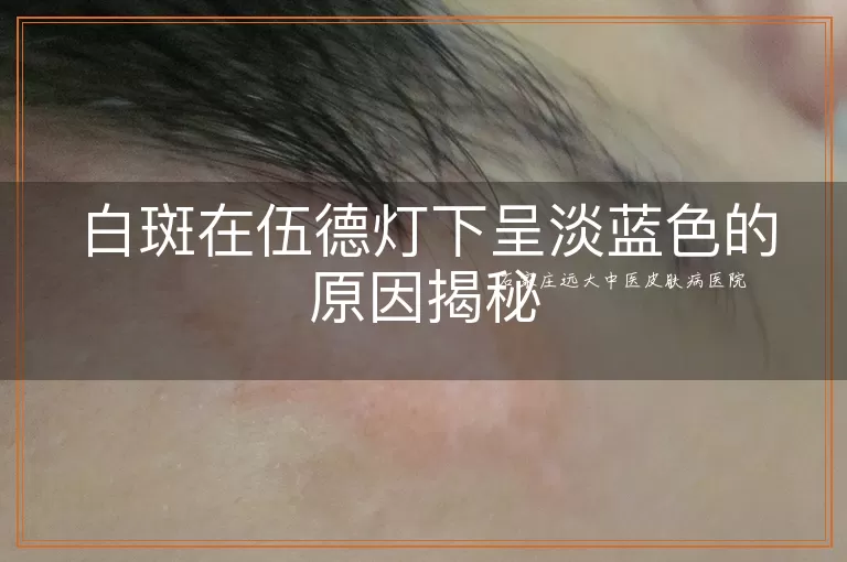 白斑在伍德灯下呈淡蓝色的原因揭秘