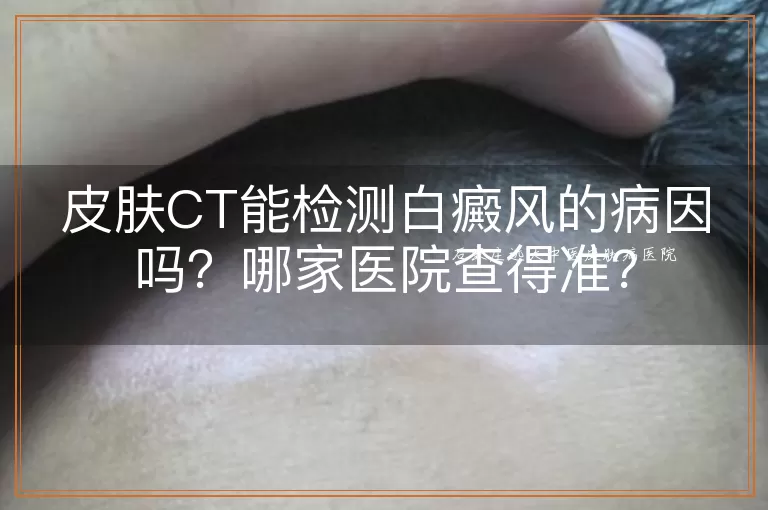 皮肤CT能检测白癜风的病因吗？哪家医院查得准？