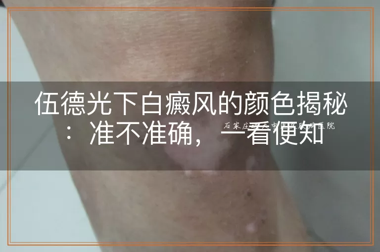 伍德光下白癜风的颜色揭秘：准不准确，一看便知