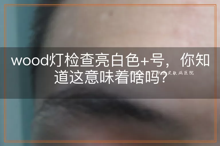 wood灯检查亮白色+号，你知道这意味着啥吗？