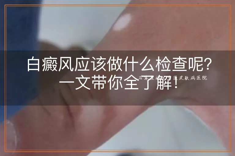 白癜风应该做什么检查呢？一文带你全了解！