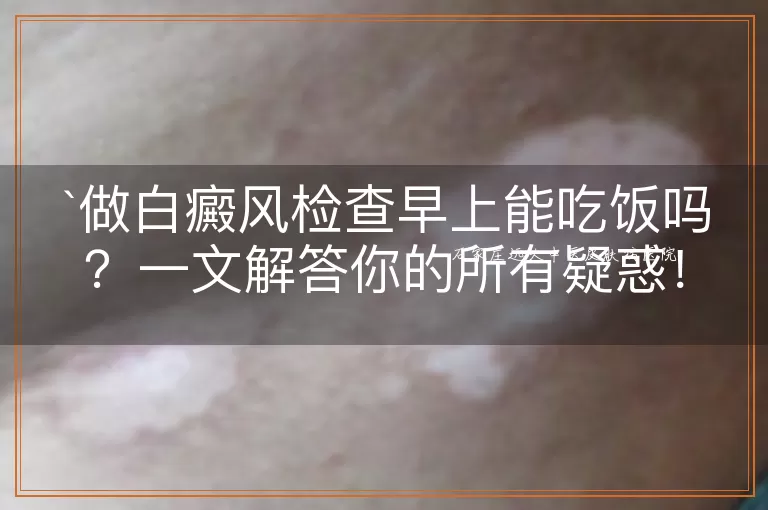 做白癜风检查早上能吃饭吗？一文解答你的所有疑惑！
