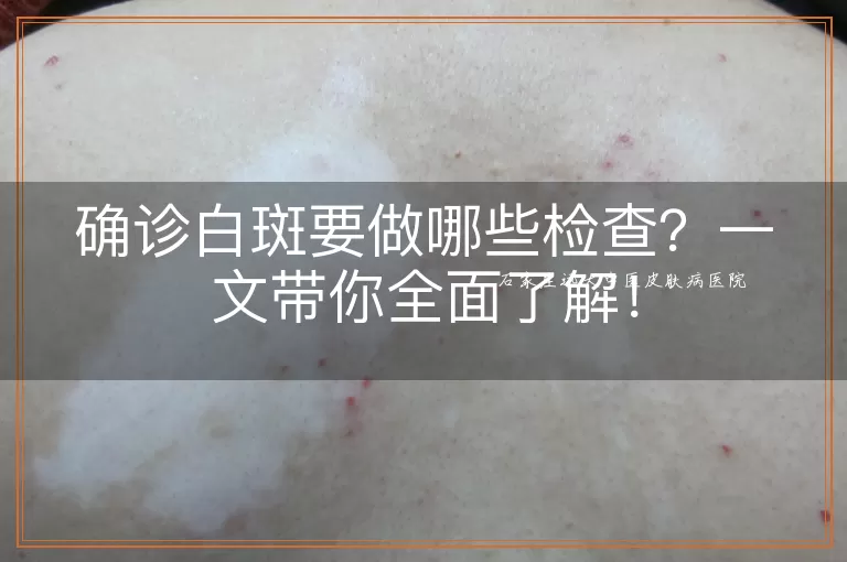 确诊白斑要做哪些检查？一文带你全面了解！