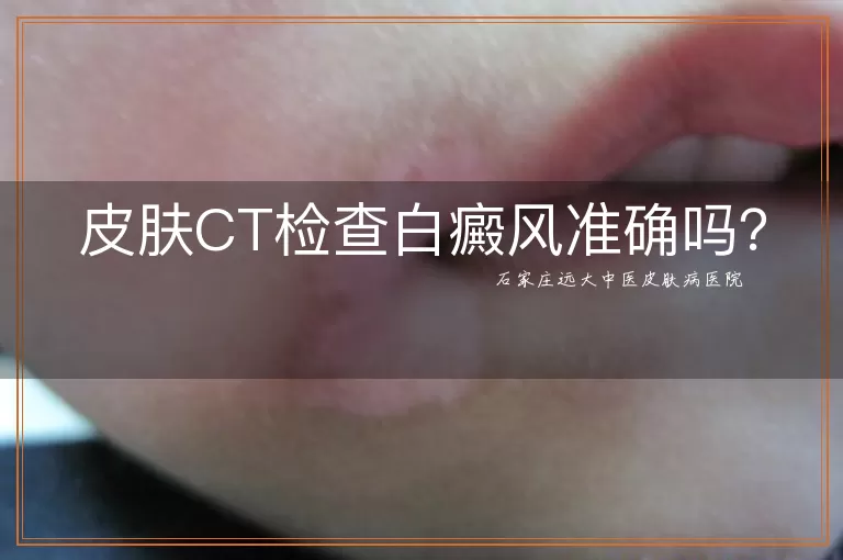 皮肤CT检查白癜风准确吗？