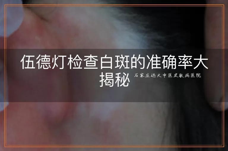 伍德灯检查白斑的准确率大揭秘