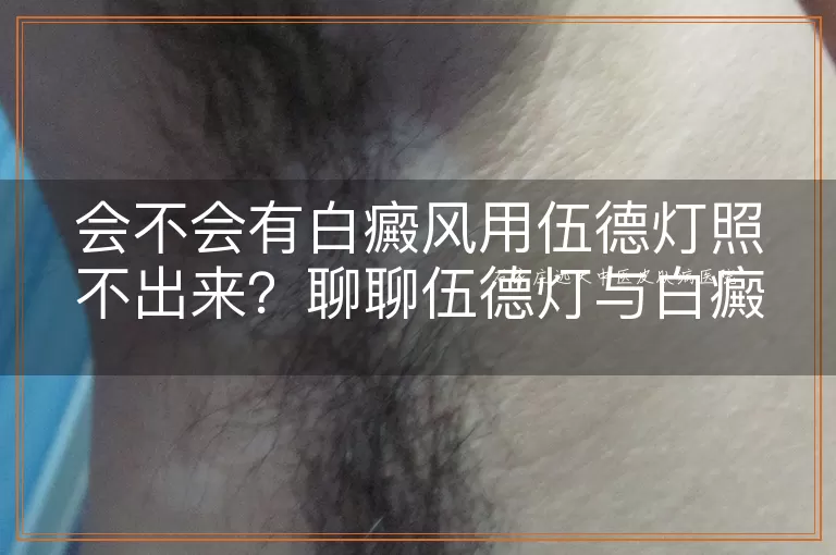 会不会有白癜风用伍德灯照不出来？聊聊伍德灯与白癜风的检测