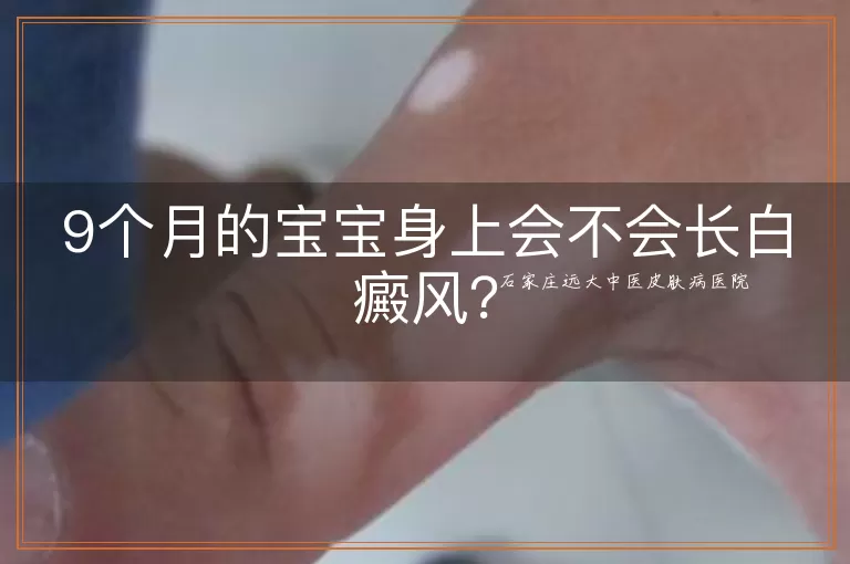 9个月的宝宝身上会不会长白癜风？