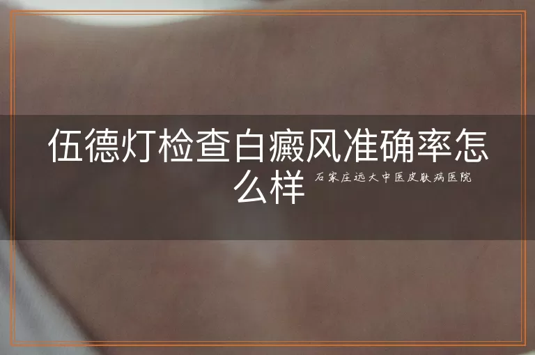 伍德灯检查白癜风准确率怎么样