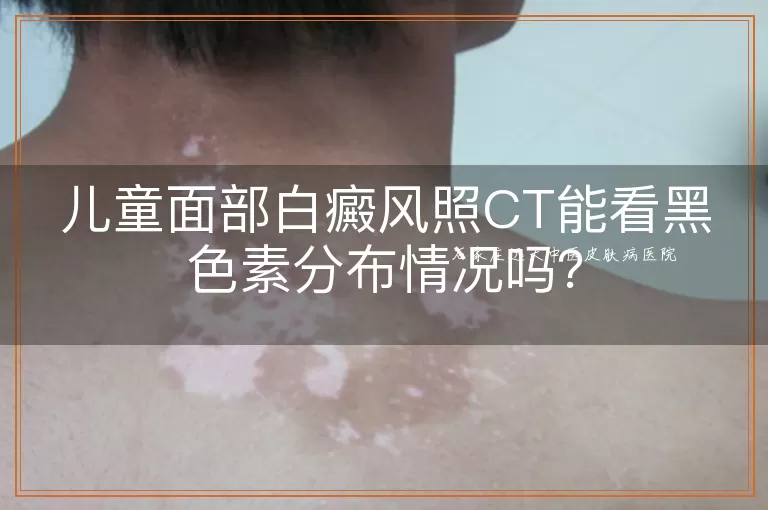 儿童面部白癜风照CT能看黑色素分布情况吗？