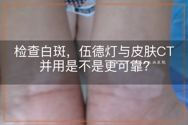 检查白斑，伍德灯与皮肤CT并用是不是更可靠？