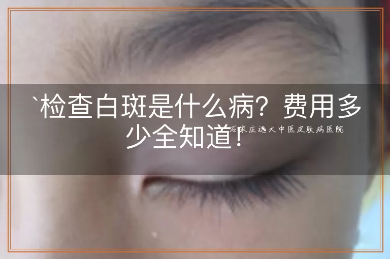 检查白斑是什么病？费用多少全知道！