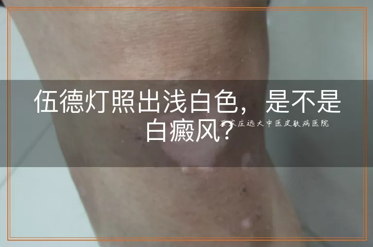伍德灯照出浅白色，是不是白癜风？