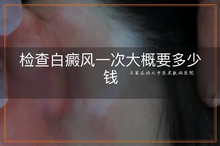 检查白癜风一次大概要多少钱