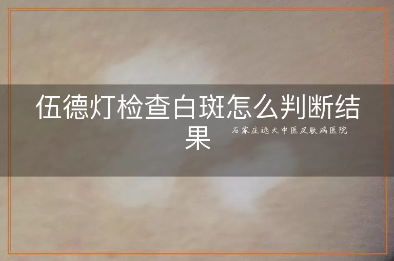 伍德灯检查白斑怎么判断结果