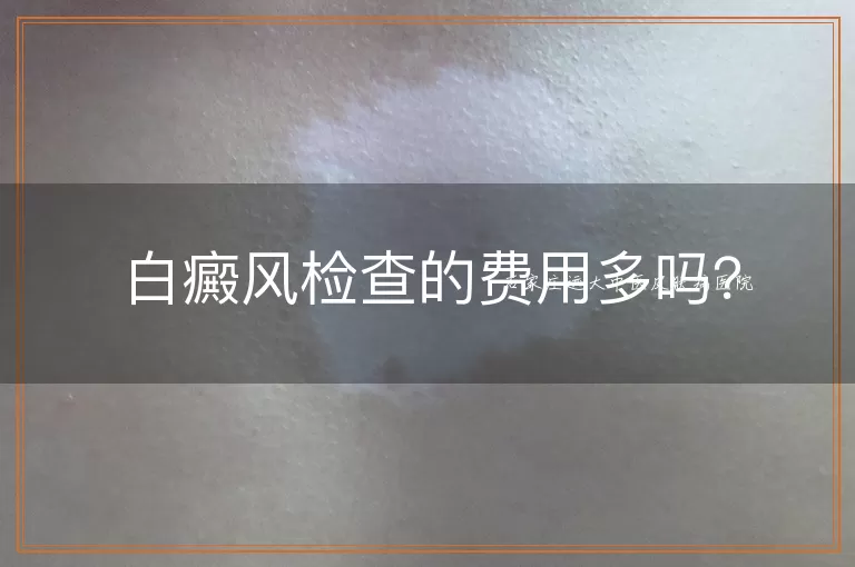 白癜风检查的费用多吗？