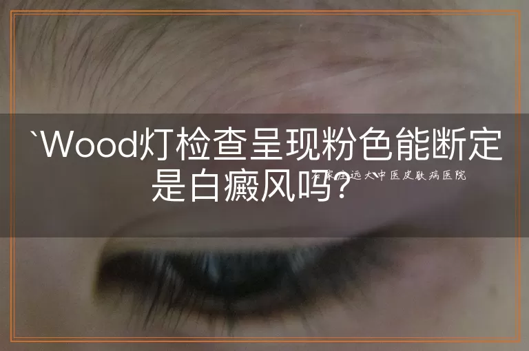 Wood灯检查呈现粉色能断定是白癜风吗？