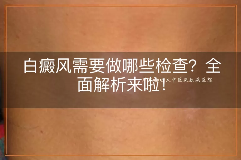 白癜风需要做哪些检查？全面解析来啦！