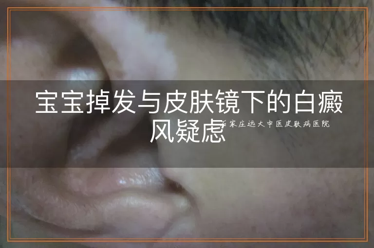 宝宝掉发与皮肤镜下的白癜风疑虑