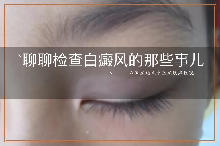 聊聊检查白癜风的那些事儿