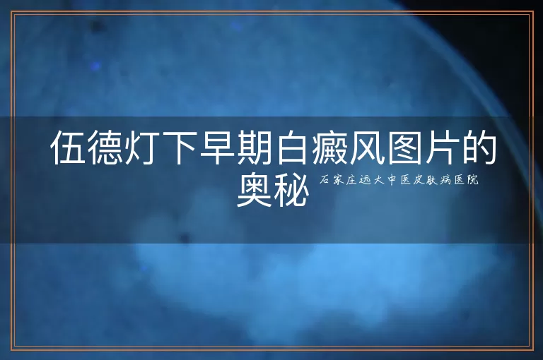 伍德灯下早期白癜风图片的奥秘