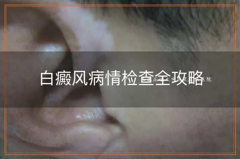 白癜风病情检查全攻略