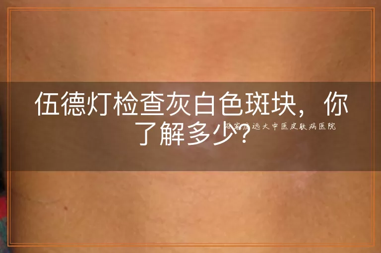 伍德灯检查灰白色斑块，你了解多少？