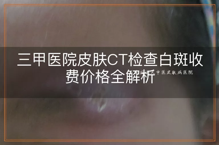 三甲医院皮肤CT检查白斑收费价格全解析