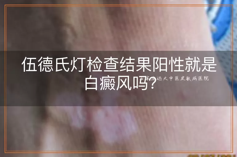 伍德氏灯检查结果阳性就是白癜风吗？