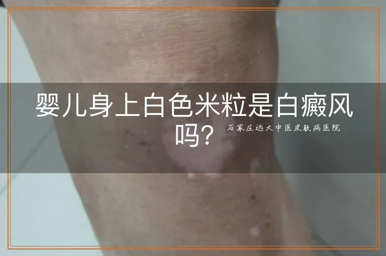 婴儿身上白色米粒是白癜风吗？