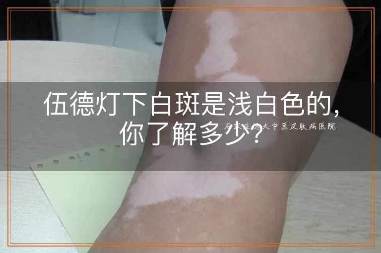伍德灯下白斑是浅白色的，你了解多少？