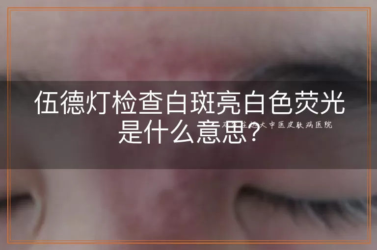 伍德灯检查白斑亮白色荧光是什么意思？