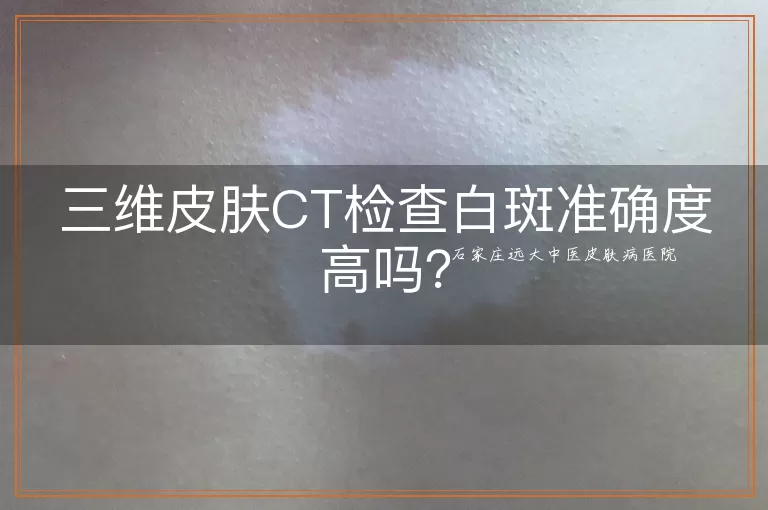 三维皮肤CT检查白斑准确度高吗？
