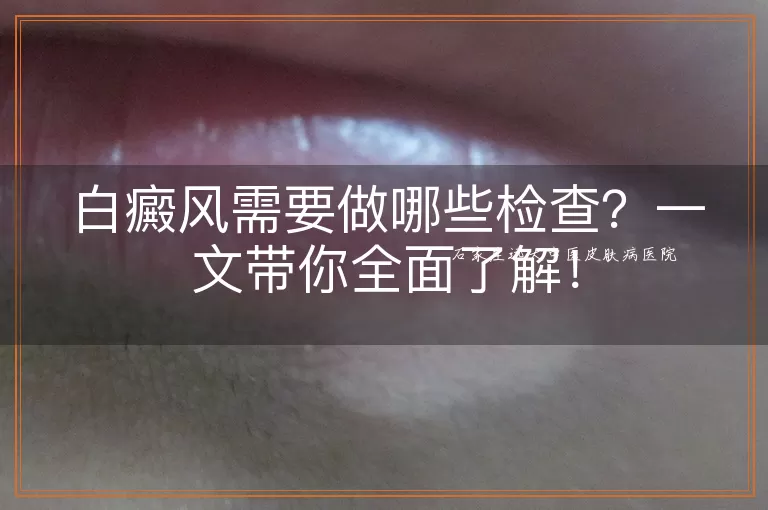 白癜风需要做哪些检查？一文带你全面了解！