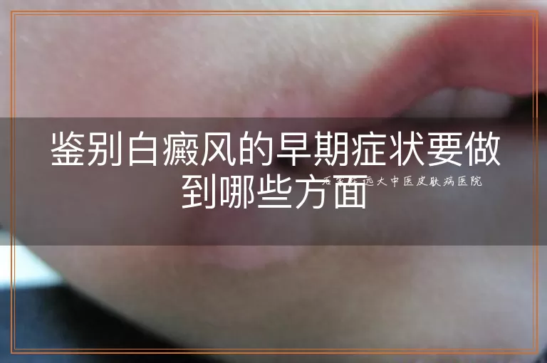 鉴别白癜风的早期症状要做到哪些方面