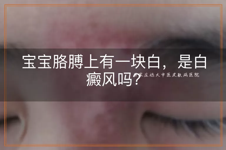 宝宝胳膊上有一块白，是白癜风吗？