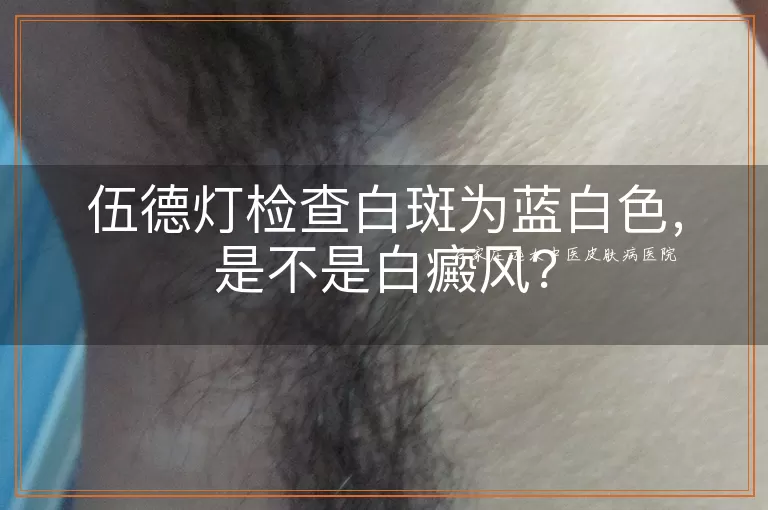 伍德灯检查白斑为蓝白色，是不是白癜风？